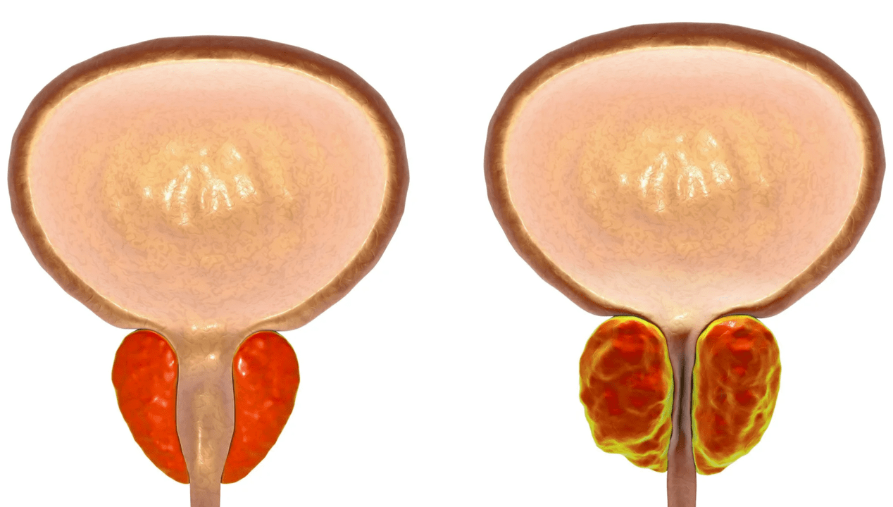 Viêm tuyến tiền liệt là gì