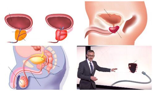 tuyến tiền liệt khỏe mạnh và bị bệnh